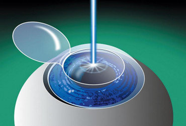 Cirugia refractiva - LASIK